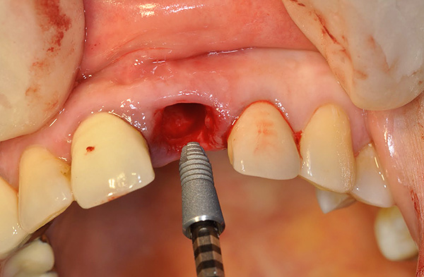 Infelizmente, nem todas as cidades têm médicos trabalhando com o sistema de implantes Astra Tech.