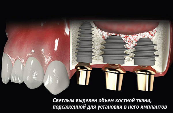 Il sollevamento del seno consente di ripristinare un volume sufficiente di tessuto osseo per la successiva installazione di impianti al suo interno.