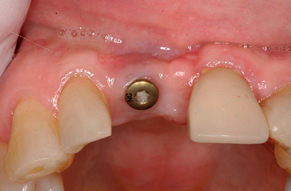 Il prezzo può anche essere influenzato dal moncone e dalla corona utilizzati nella fase finale delle protesi (il gum shaper è mostrato nella foto).