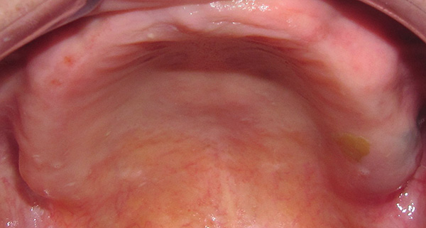 Con la completa assenza di tutti i denti nella cavità orale, non è affatto necessario ripristinare ogni dente su un impianto separato: puoi risparmiare molto ...