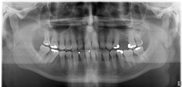 L'ortopantomogramma consente di valutare le condizioni dei denti e dei tessuti adiacenti.