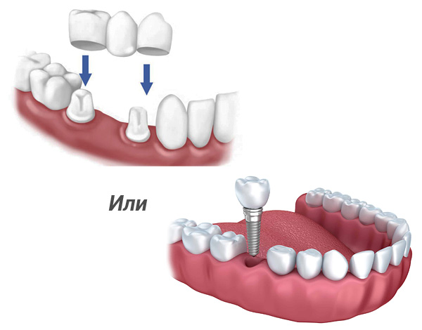Vamos descobrir o que é melhor: uma ponte dentária testada pelo tempo ou próteses modernas sobre implantes dentários ...