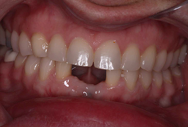 Na situação mostrada na fotografia, os dois dentes inferiores inferiores podem ser restaurados usando uma ponte convencional.