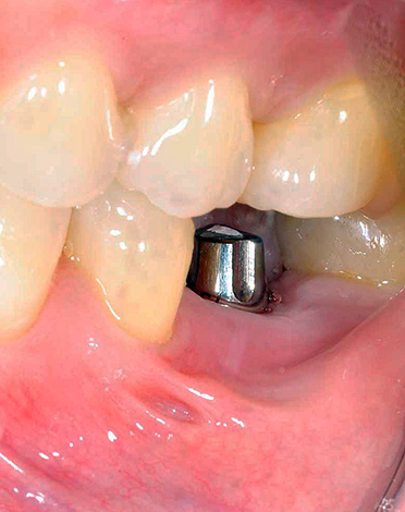 Implante de dente para mastigar.