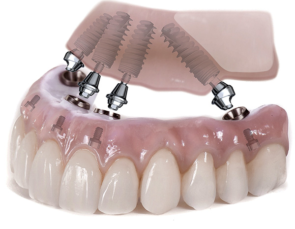 Um exemplo de prótese de todos os dentes da mandíbula superior em implantes usando a tecnologia All-on-4.