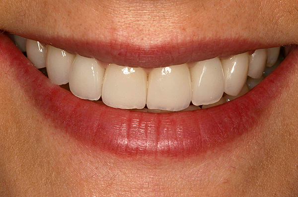 Na grande maioria dos casos, o uso de implantes dentários tem muito mais vantagens do que instalar uma ponte.
