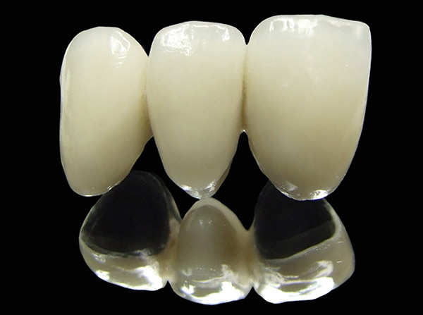 Ponte de metal-cerâmica para próteses de um dos dentes da frente.