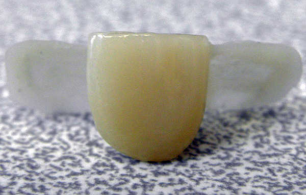 Uma ponte adesiva é presa aos dentes adjacentes colando pequenas placas a eles.