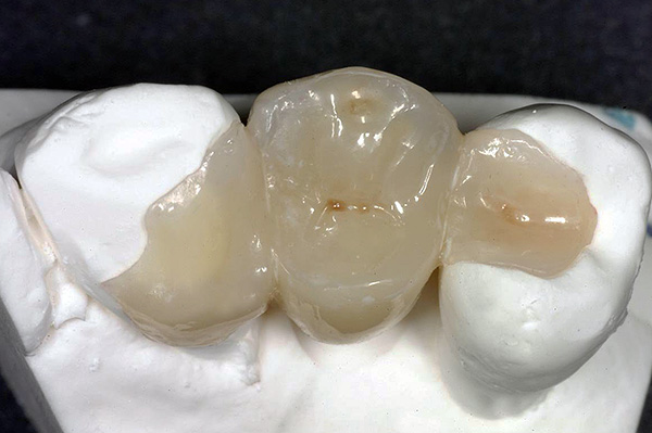 Outra versão da ponte adesiva (para reabastecer o dente de mascar).