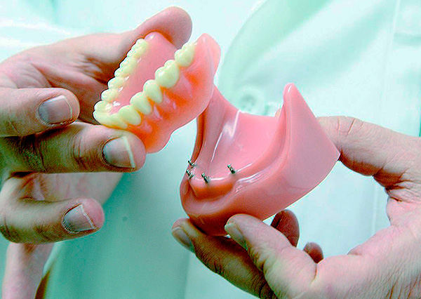 Os mini-implantes permitem que você fixe com segurança a prótese na cavidade oral e não tenha medo de que ela caia durante uma conversa.