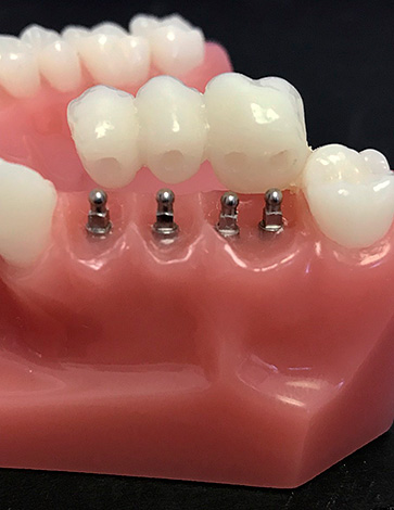 A instalação de uma ponte em mini-implantes é realizada apenas em casos raros.