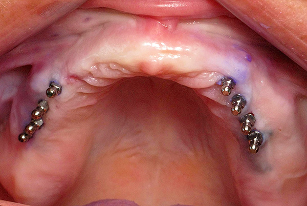 Quanto mais implantes forem instalados, mais segura será a fixação da prótese e mais uniformemente será distribuída a carga mastigatória.
