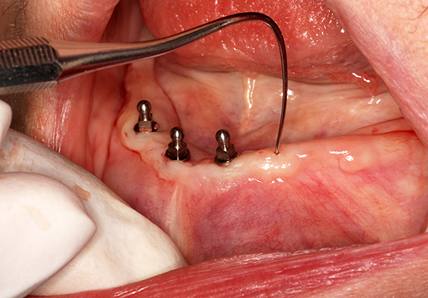 A instalação de mini-implantes é menos traumática do que a instalação de implantes clássicos.